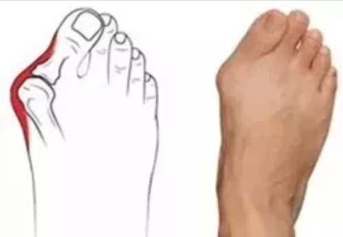 好痛好丑！悲催的“大脚骨”究竟是什么？