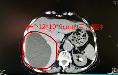 肝里有个“大芒果”！三个小孔解决老奶奶的“腹痛”烦恼！