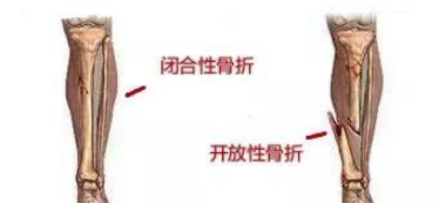 骨折都住院了，医生还不马上手术，咋回事？