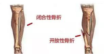 骨折都住院了，医生还不马上手术，咋回事？