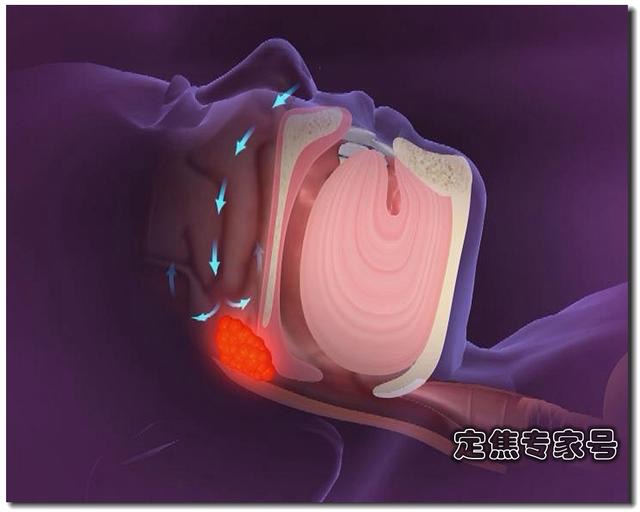 打呼噜？莫让小孩交上这个“坏朋友”！