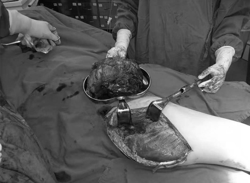 【罕见】奋战7小时，大腿上精准切除“皮球”！