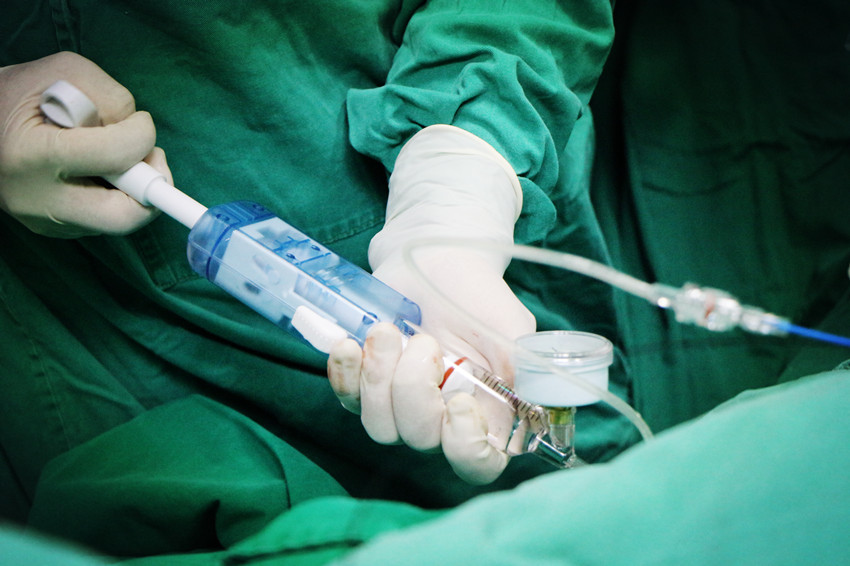 【顺德首例】成功！超声引导下超高压球囊PTA手术在我院顺利开展！