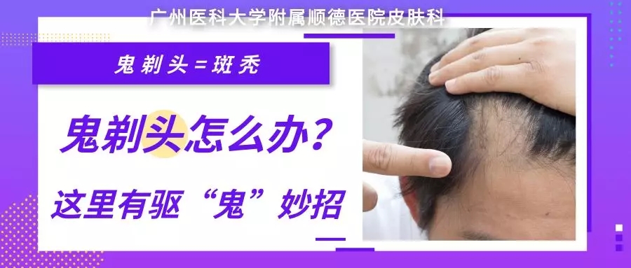 【科普】“鬼剃头”怎么办？这里有驱“鬼”妙招！