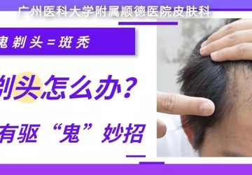 【科普】“鬼剃头”怎么办？这里有驱“鬼”妙招！
