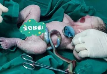 惊险！B超查出胎儿脐动脉栓塞，多学科出击保母子平安
