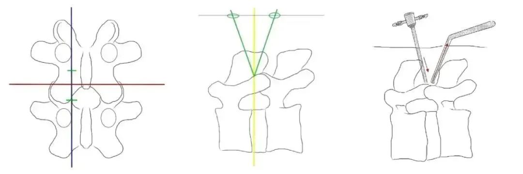 不开刀，不卧床！乐从医院骨科新型微创技术，彻底拯救你的“老腰”